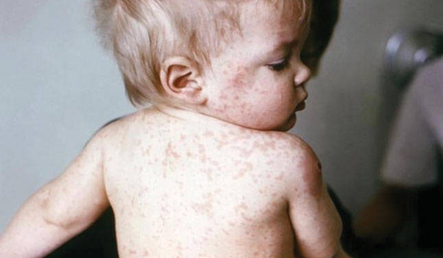 Bujanoci më i prekur se Presheva nga epidemia e fruthit